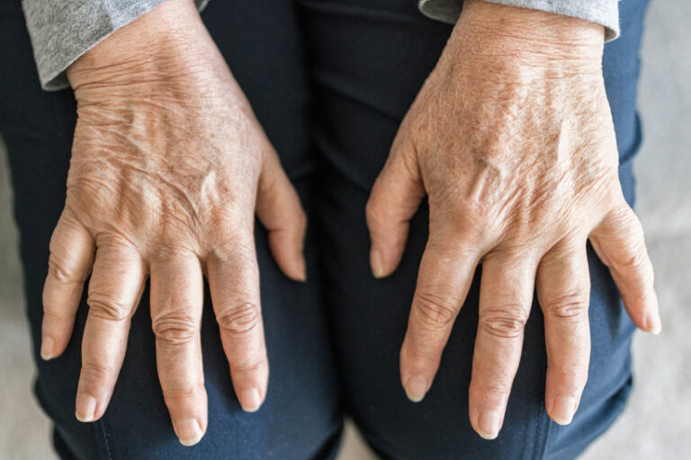 Senior woman suffering from arthritis